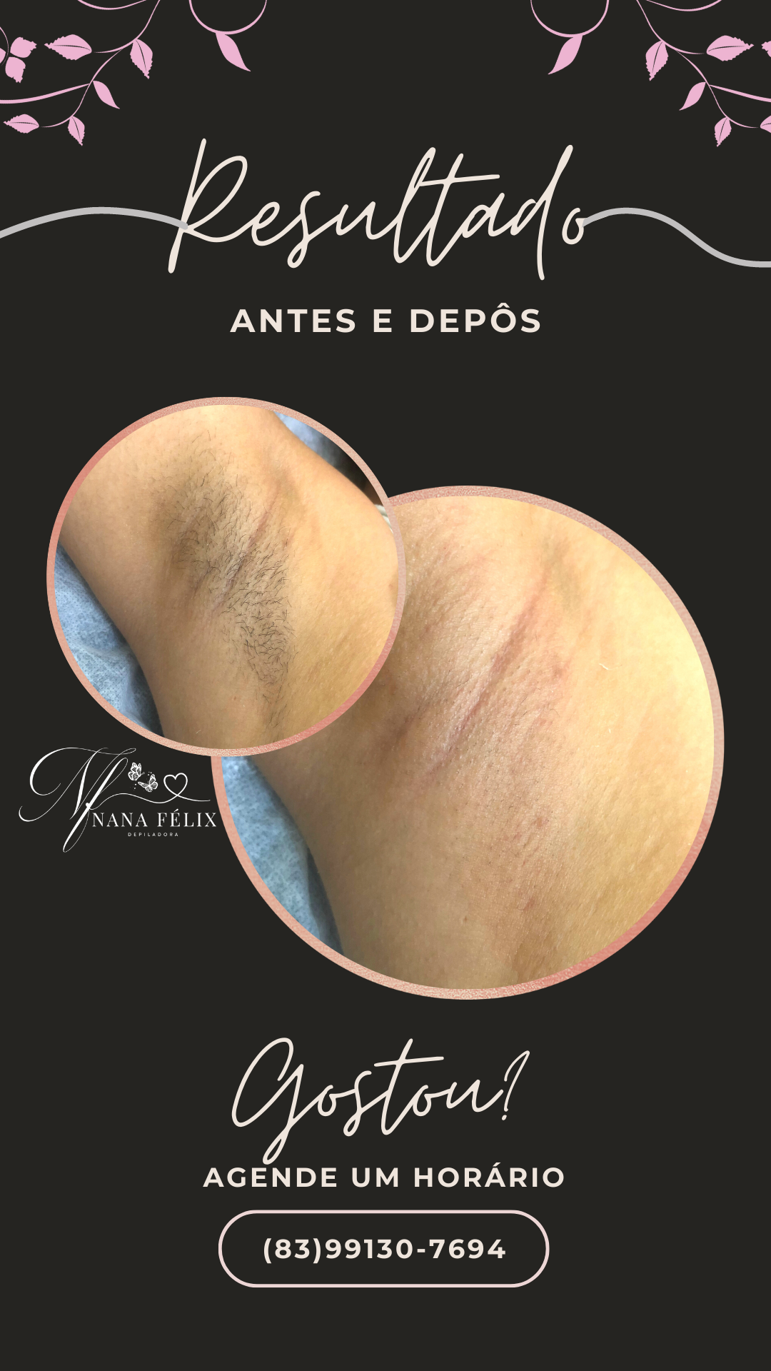 Depilação de axilas